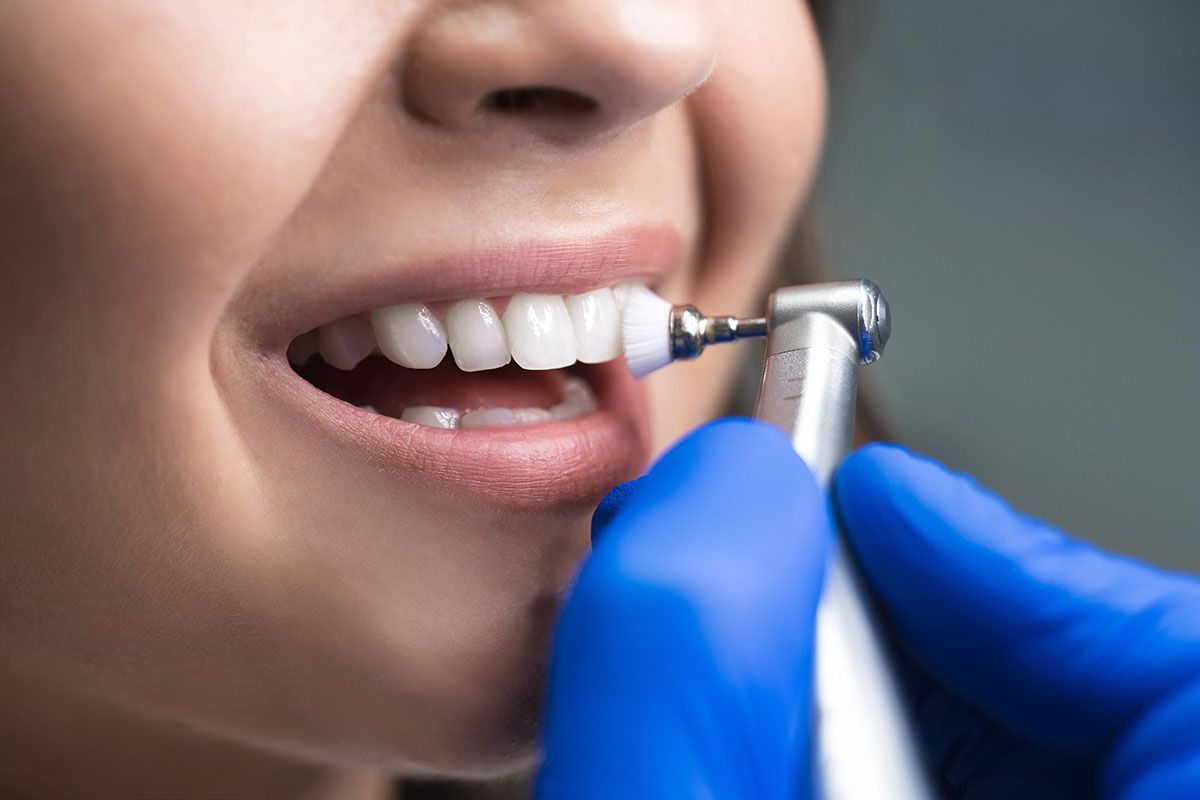টুথ পলিশিং - Azam's Dental Care
